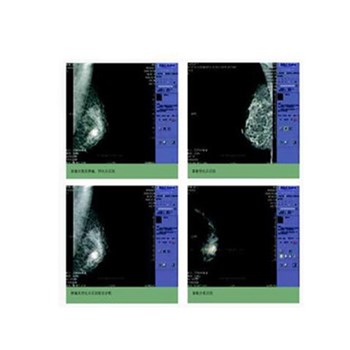 迈克（计算机辅助诊断系统）瑞乳腺CAD